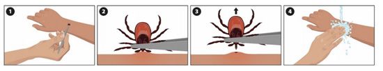 Tick Removal